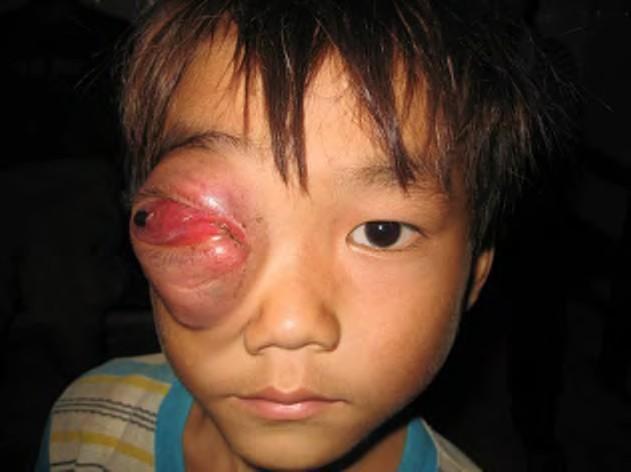 Rhabdomyosarcoma Highly malignant orbital tumor of striated muscles in children Symptoms: unilateral eye pain.