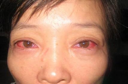 Symptoms: Red sticky eyes, usually bilaterally. Signs: red eyes with purulent discharge. No corneal or anterior chamber involvement.