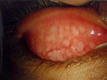 Symptoms: eyes itch (++) and are red and sore.
