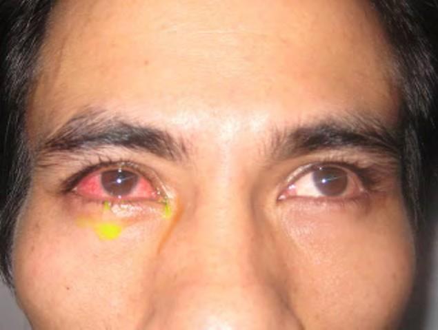 Diffuse episcleritis Inflammation of episclera, the
