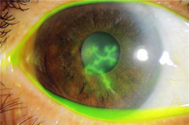 This is inflammation of the sclera. In the most severe form scleral necrosis can occur.