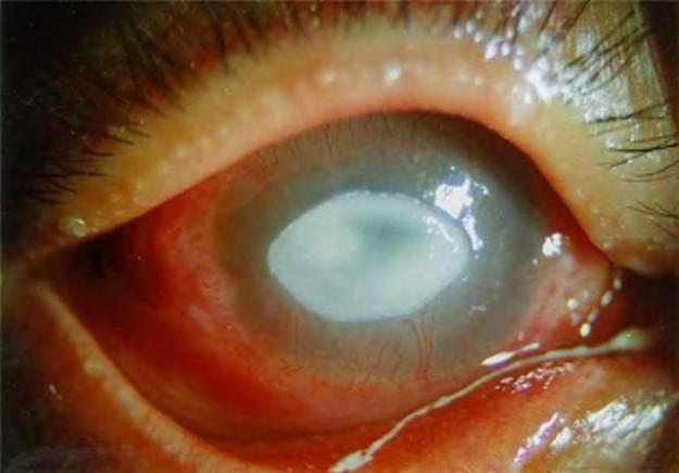 Signs: White area on cornea, may be peripheral or central.