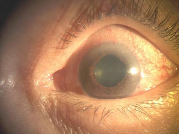 Signs: red eye with ciliary injection around iris, anterior chamber appears cloudy from cells and flare.