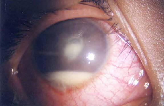 Most commonly seen after trauma or intraocular surgery.