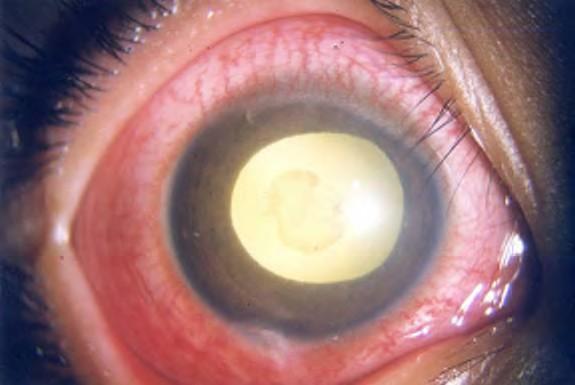 Signs: lid swelling, discharge, red eye, hypopyon, reduced vision.
