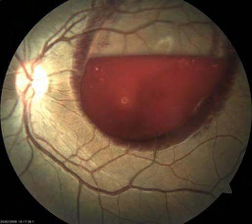Vitreous haemorrhage SUDDEN PAINLESS LOSS OF VISION Bleeding in the vitreous cavity seen in individuals with diabetes