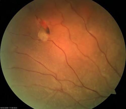 Retinal tear/detachment Retinal tear/ detachment occurs when there is separation of sensory retina from the retinal pigment epithelium.