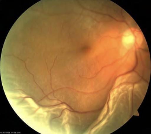 The patient may have encountered a recent history of increased number of visual floaters and/ or visual flashes. There may be a dark shadow in the vision of the affected eye.