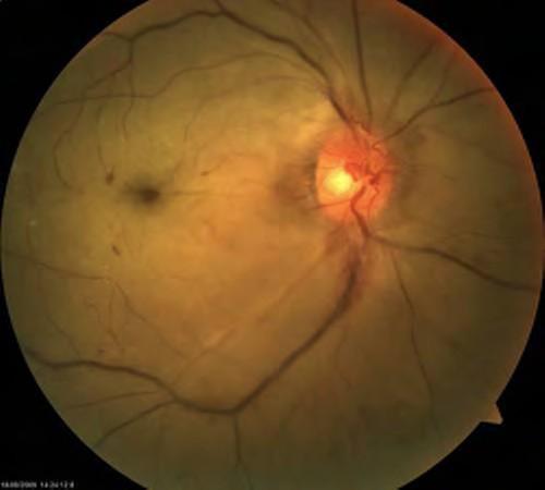 Central retinal artery occlusion Blocked blood flow in the central retinal artery, which often occurs in one eye.