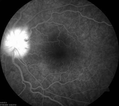Investigation and Management : Screen for diabetes and hypertension, exclude glaucoma.