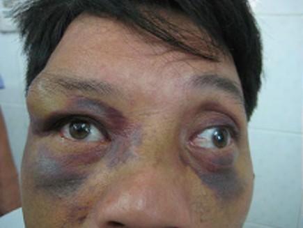 Haematoma (black eye) is the most common result of blunt injury to the eyelid.