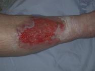 steroids to control inflammatory exudate from wounds such as pyoderma gangrenousum, vasculitic or rheumatoid ulcers.