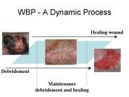 Many wounds require maintenance debridement using techniques that will not delay the healing process Once it has been established that the wound will benefit from debridement, it is necessary to: 1.