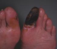 Figure 4 - Safe dry gangrene in a toe that is auto-amputating Debridement methods A number of inter-related options for wound debridement exist (Box 2).