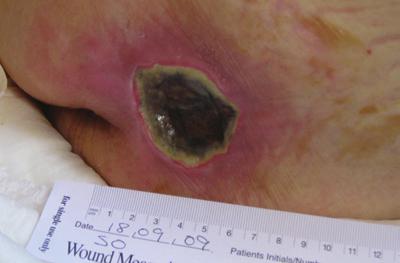 Debridement is the removal of dead tissue (also known as non-viable or devitalised tissue), infected or foreign material from the wound bed (Wounds UK, 2013).