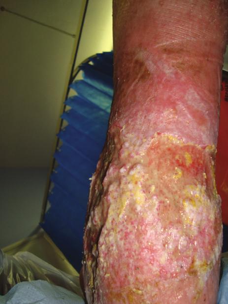 Figure 1 Figure 2 Case 2 Presentation: A vascular consultant referred this patient to the tissue viability service for assessment of recurrent mixed aetiology leg ulcers.