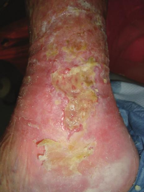 Figure 1 Figure 2 Case 3 Presentation: This patient had a deteriorating venous leg ulcer that was leaking serous fluid.