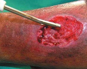 conventional surgical excision (6) 1a 1b Tissue preservation