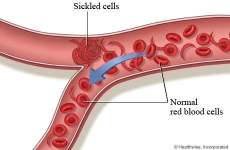 ABOUT SICKLE CELL DISEASE Anticonvulsant Drugs Sickle Cell Disease (SCD) or sickle cell anemia is a hereditary genetic disease characterized by the presence of abnormal crescent-shaped red blood