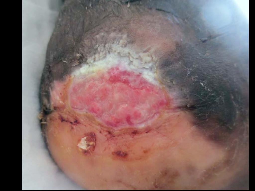 6 th Application Week 6 Continued reduction in wound size and maceration improved. Pre-debridement Date: 8/3/15 Wound Size: 1.4 x 3.0 x 0.