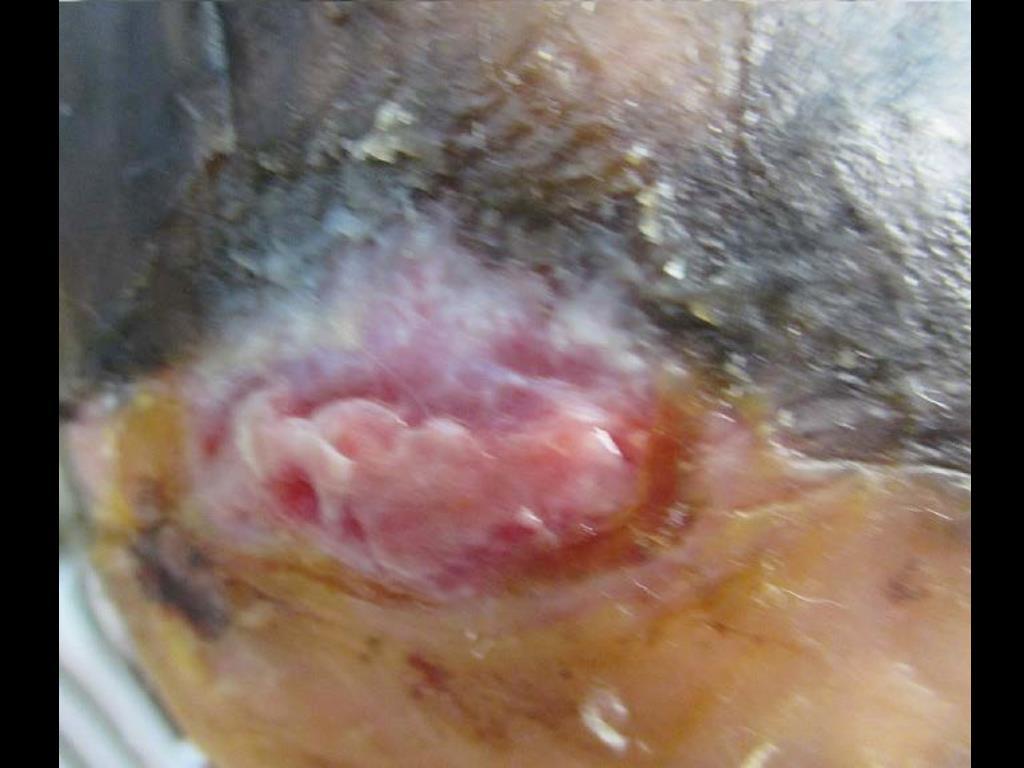 8 th Application Week 8 Continued reduction in wound size with no signs of peri-wound maceration. Pre-debridement Date: 8/17/15 Wound Size: 0.7 x 2.1 x 0.