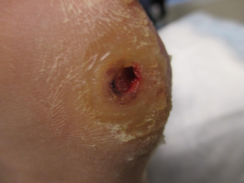 59 y/o female with a history of a puncture wound and