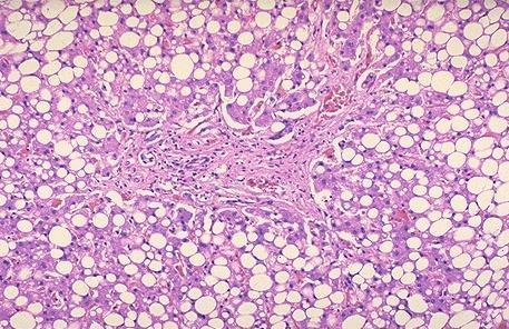 The role of liver biopsy Isolated steatosis Steatohepatitis/NASH o
