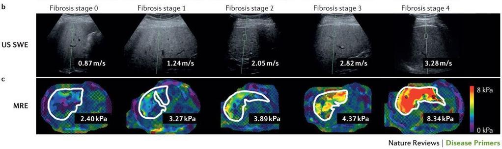 How reliable is non invasive assessment of liver fibrosis in NAFLD?