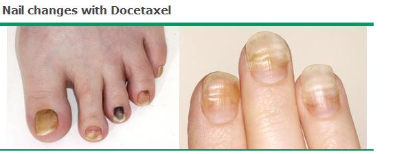 Docetaxel - The Ugly Courtesy of Dr.