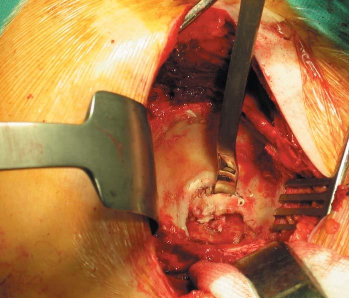 Surgical Protocol Pre-Operative Planning Pre-operative templating will usually allow the surgeon to select the implant sizes appropriate for the hip to be reconstructed and to plan the position in