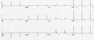 Wellens syndrome or LAD coronary T-wave syndrome.