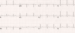 elevation; normal precordial R-wave progression. The common form shows deep T wave inversion in precordial leads.