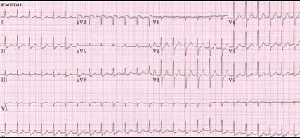 Case 3: 51 year old complains of palpitations. What is the rhythm?
