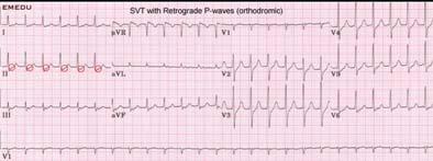 40 Case 3: AV Nodal Re entrant Tachycardia No definite p waves seen before the