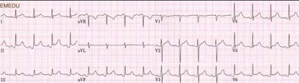 May see retrograde p waves (seen as pseudo-terminal S waves in leads II & avf,