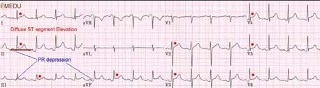 Case 4: Acute Pericarditis 43 Case 5: This patient is asymptomatic and had a