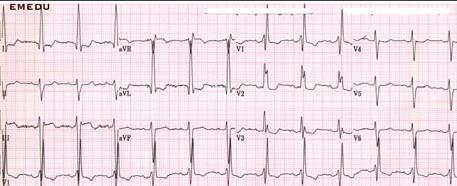 44 Right Bundle Branch Block 120 ms Complete RBBB has a widened QRS > 0.