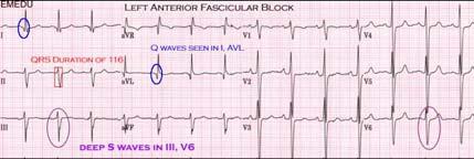 Left Anterior Fascicular Block When isolated LAFB, QRS