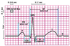Approach to EKG Interpretation Rate Rhythm Axis Intervals (PR, QRS, QT)