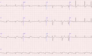 Case 1: Intervals Normal QRS complex duration is 60 100 msec (1.5 to 2.