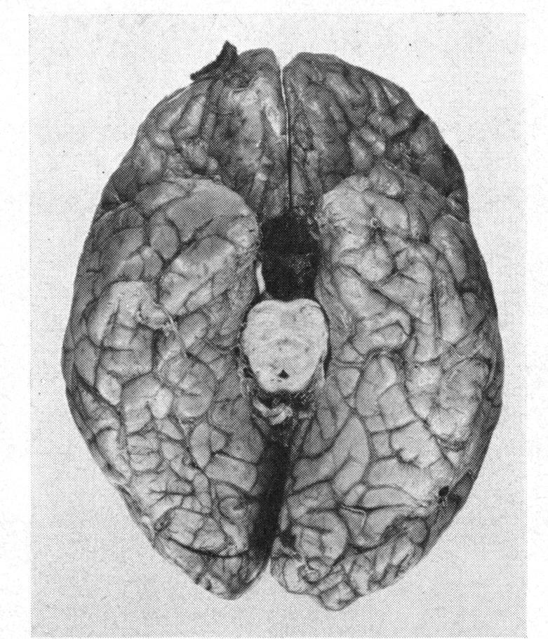 256 FIG. 6.-Case 2. Basal view of brain showing cavity excavated by the aneurysm. Comment.