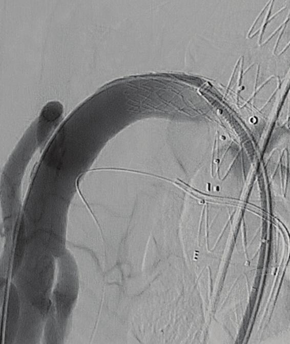 Cannulation of the renal arteries and the SM (). Control of the stented SM (). Control of the stented RR (C).