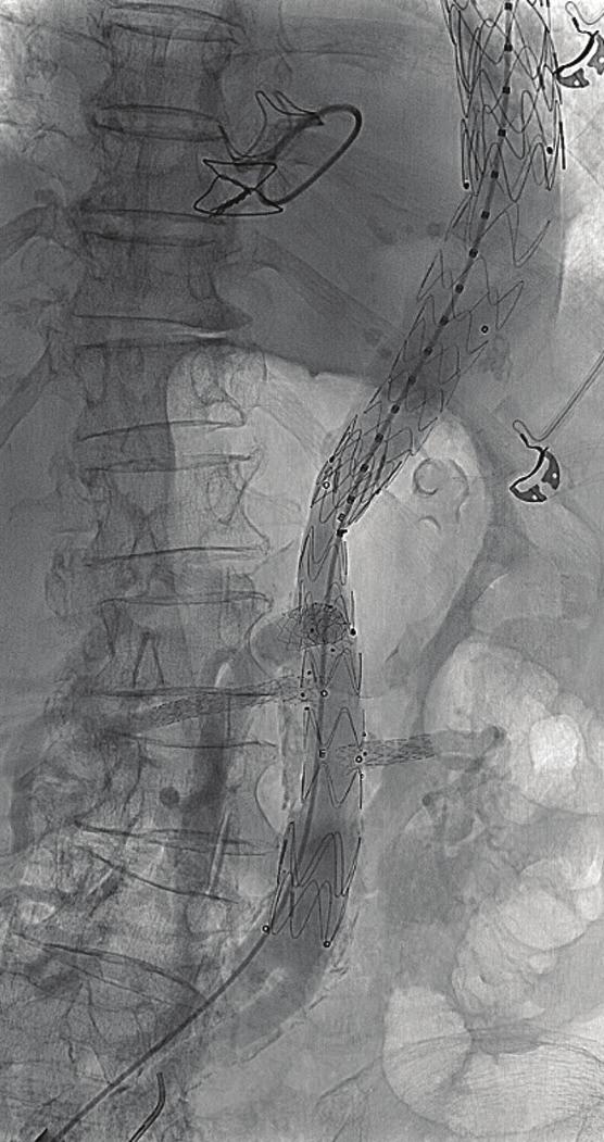 renal artery (RR), 6 mm/26 mm; left renal artery (LR), 6 mm/58 mm [Lifestream, ard Peripheral Vascular]) (Figure 3 D).