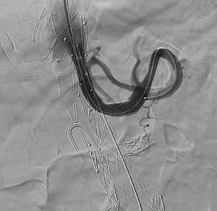 Subsequently, a 45-cm, 12-F shuttle sheath and a coaxial 55-cm, 7-F sheath were both advanced into the stent graft via the left axillary artery.