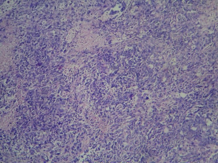 Fig.4 Prominent lymphocytic infiltrate Fig.5 29.73% 70.27% Absent Present Fig.