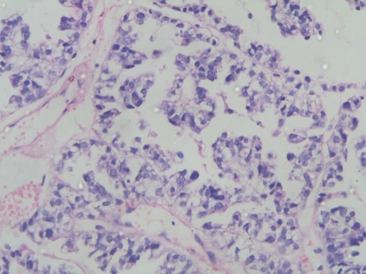 Fig.10-Clear cell carcinoma showing clear cells with distinct cell borders arranged in tubulocystic and tubulopapillary patterns Fig.