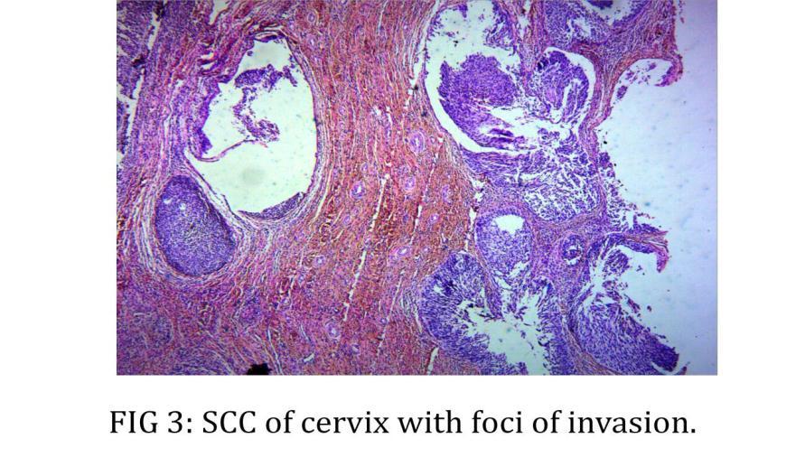 3, MICROSCOPY The cervical lesion consisted of invasive squamous cell carcinoma, moderately differentiated [FIG 3] extending up over the endometrial