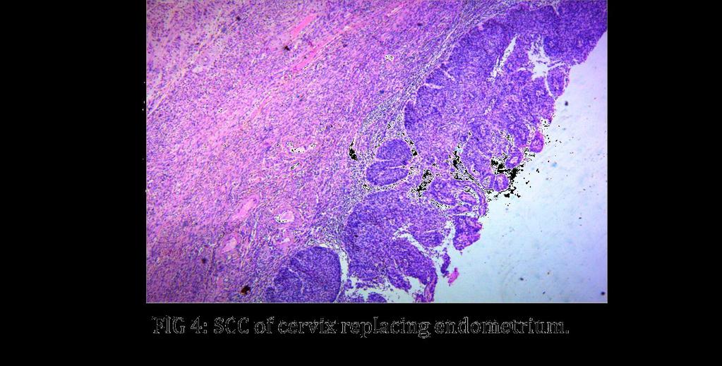 The entire endometrial surface was replaced with squamous cell carcinoma in situ without involving the underlying myometrium.