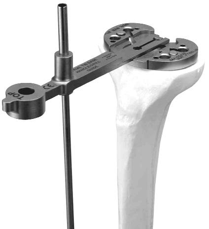TIBIAL BASEPLATE PREPARATION Select the Trial Tibial Baseplate Template that provides the optimal proximal tibial bone coverage FIGURE 13.