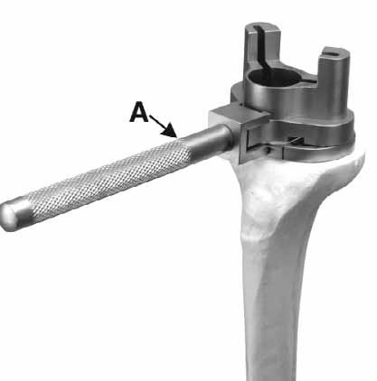 Tibial Baseplate Fixation Pins FIGURE 14. NOTE Align the distal end of the External Check Rod with the second toe. Remove the Tibial Baseplate Handle and External Check Rod Figure 14.